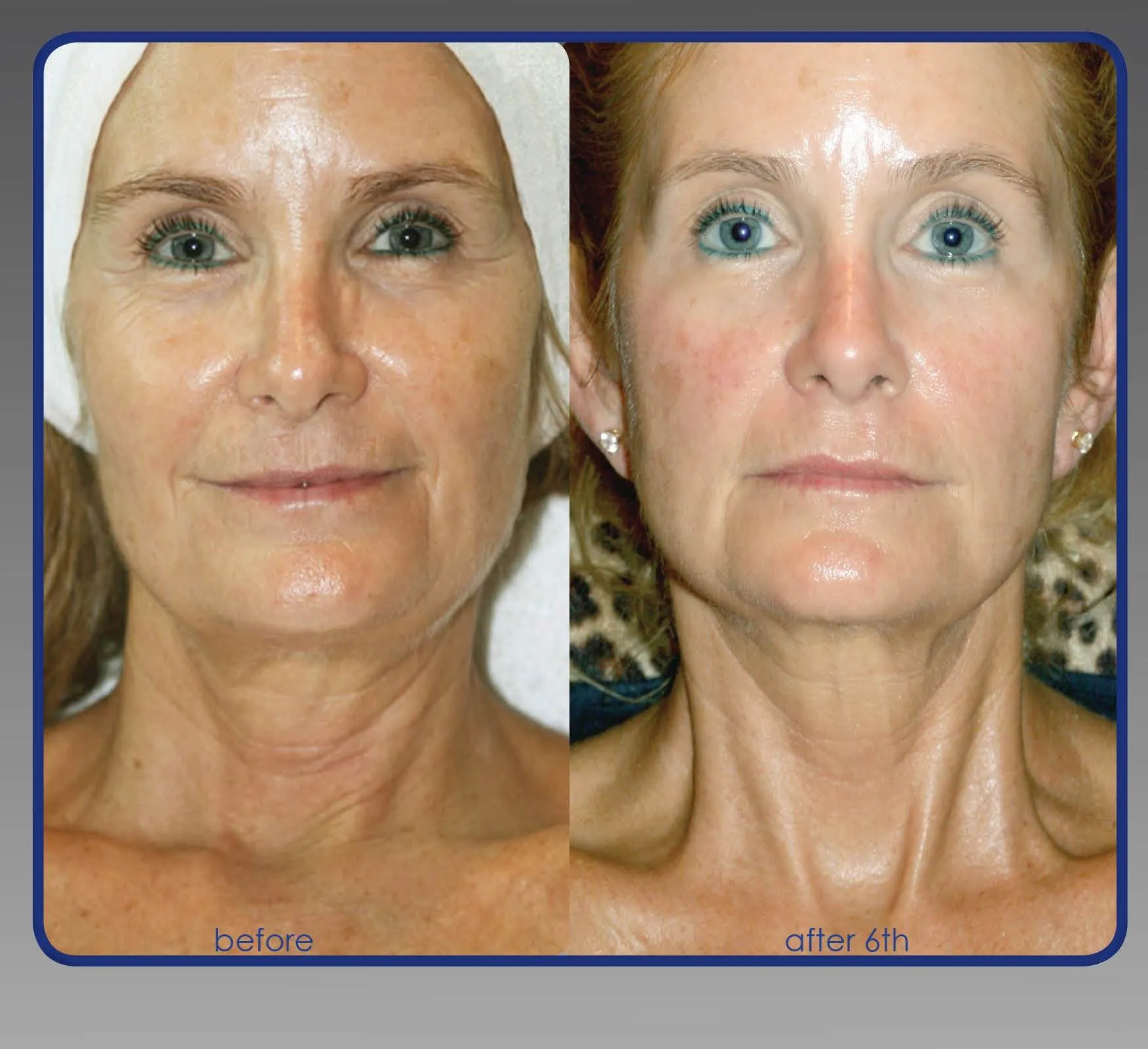 Vorher-Nachher Ergebnis einer Anti-Aging Behandlung